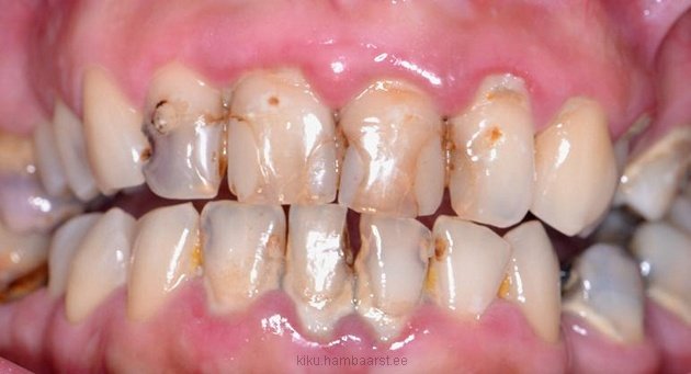 Kaariesekahjustusega hambad