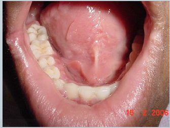 Mundhöhlenkrebs Anfangsstadium