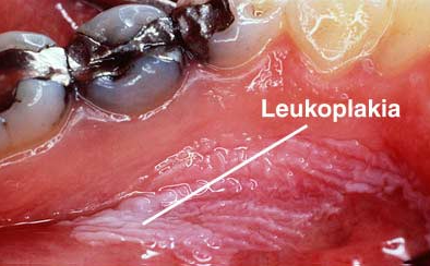 Leukoplaakia